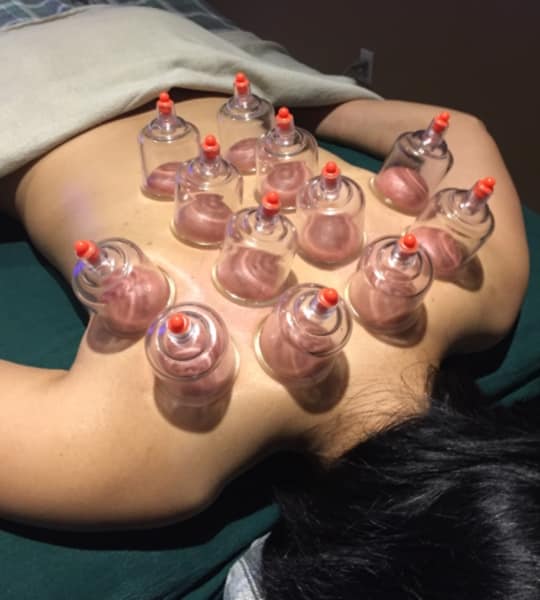 Girl getting cupping therapy on her back for tension reduction and holistic healing